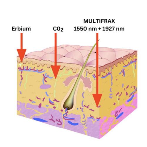 Multifrax | Multifrax JB